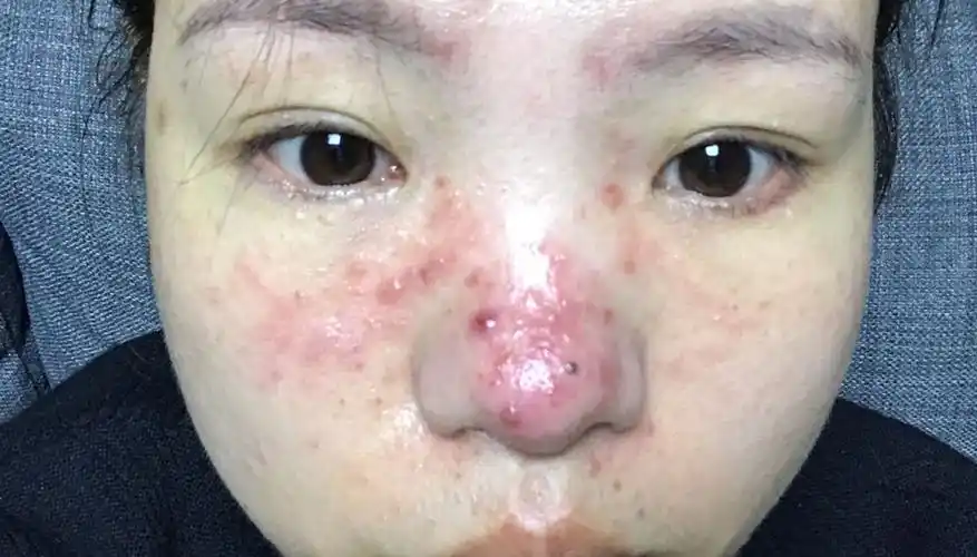 杨希川教授-皮肤科医生 已回答?问答