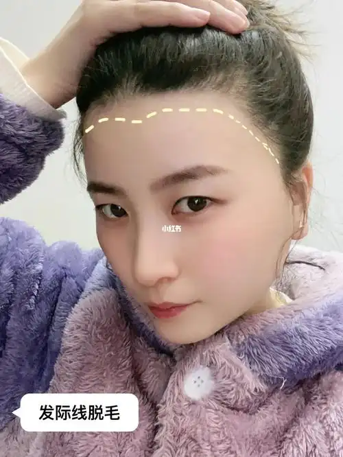 低发际线脱毛提高脱完真的额头又宽又光