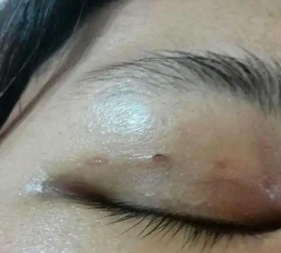 双眼皮埋线线头外露可以自己剪掉吗