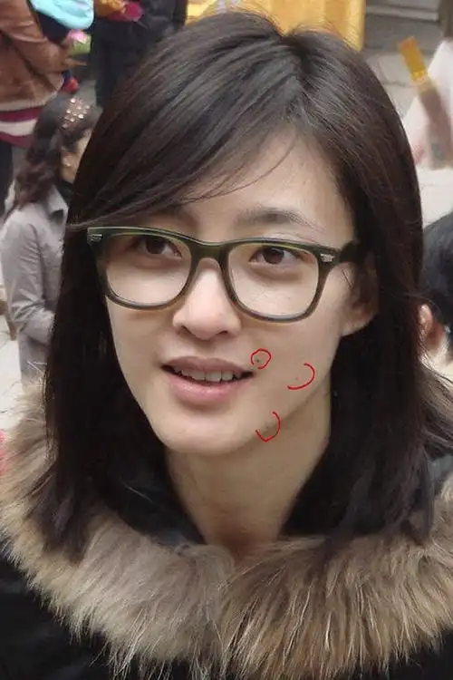 有些痣影响美吗?