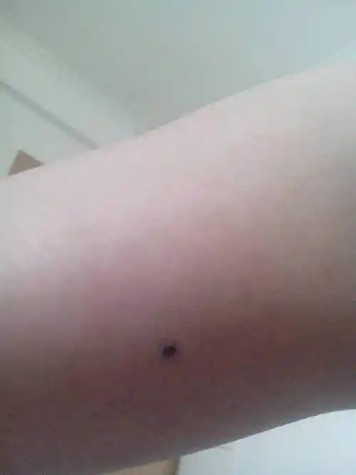 小腿上长了个痣 有没有问题