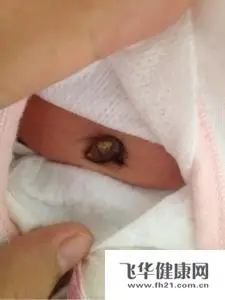 新生儿肚脐出血该怎么办