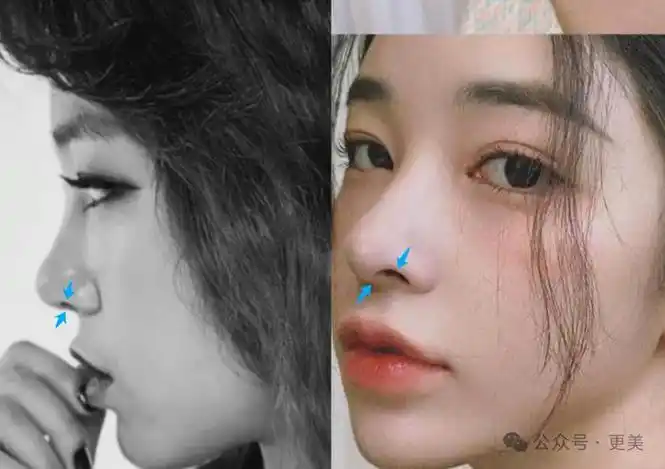 同时下移假体假体,给山根留出喘息空间,这是当下流行「塌鼻梁」的