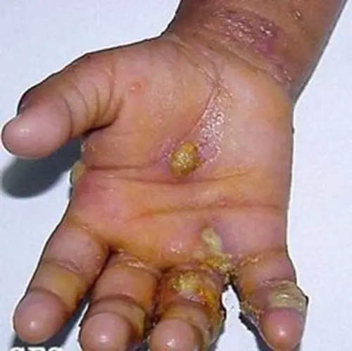 孕妇疥疮初期腹部皮肤症状图片