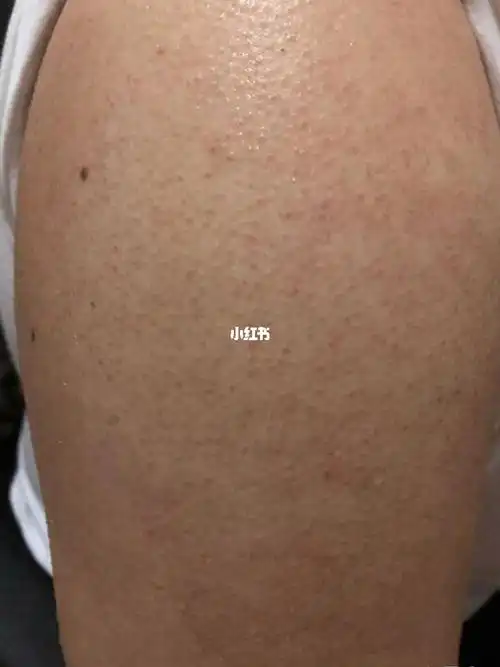 毛囊炎 我是从去年的时候,手臂上就开始长痘痘了,一直反反复复的,平时