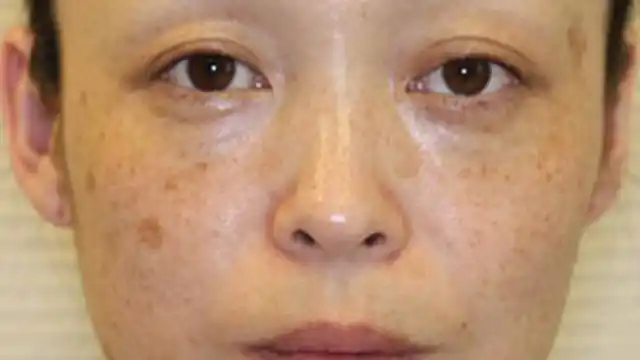 岁的袁大妈脸上长了很多的斑点,就像下面这张图一样,其实这个就是肝斑