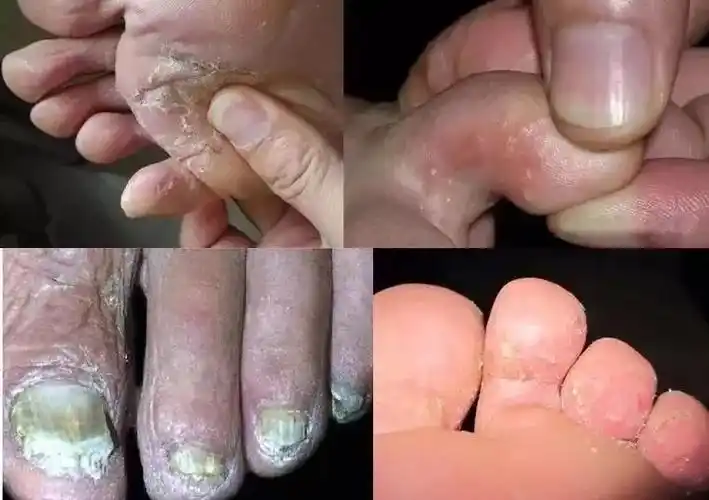 10年脚气一喷就好picc承保这只天然草本精华专治脚臭脚痒