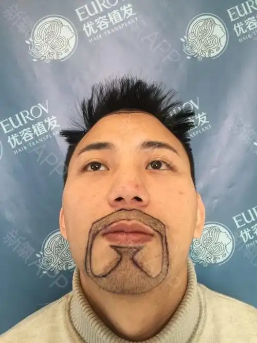 看到德美的优容植发这边有艺术植胡须这个项目,又特地上门和医生面诊