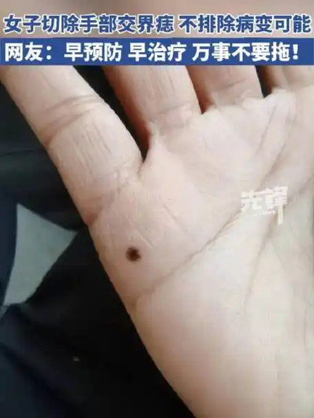 田女士三年前发现手部小拇指附近长出一颗小痣,一开始并未在意,但之后