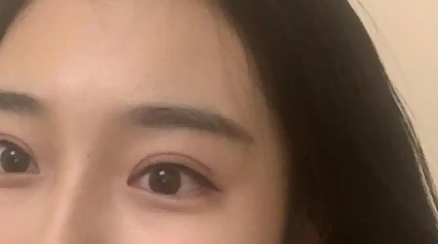 北京割的标准全切扇形双眼皮