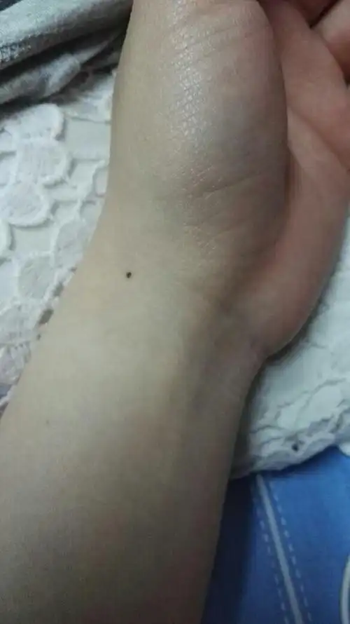 这个痣是在手腕内侧还是外侧