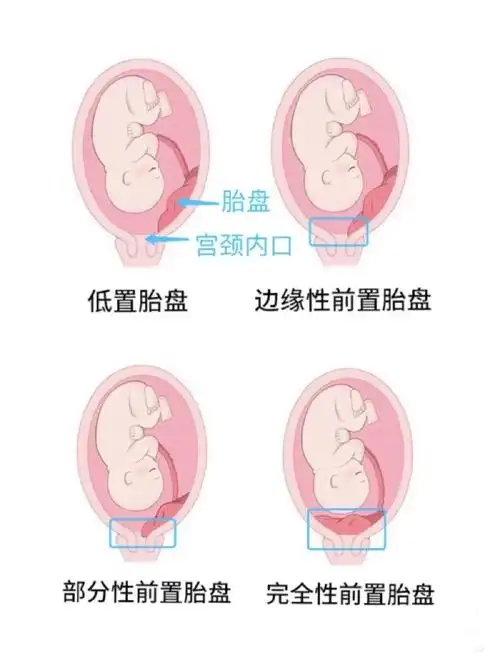 胎盘附着于子宫下段,胎盘边缘达到或覆盖宫颈内口,位置低于胎儿先露