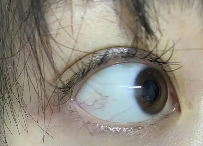 请问这种程度的红血丝是正常的麽 正常眼睛里面是一根红血丝都没有的