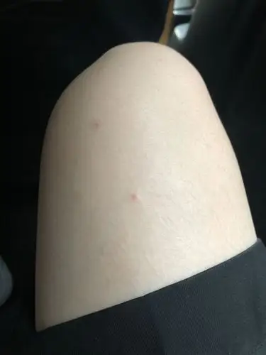 匿名用户   2019-10-08   展开全部 这个有可能是毛囊炎,症状比较轻微