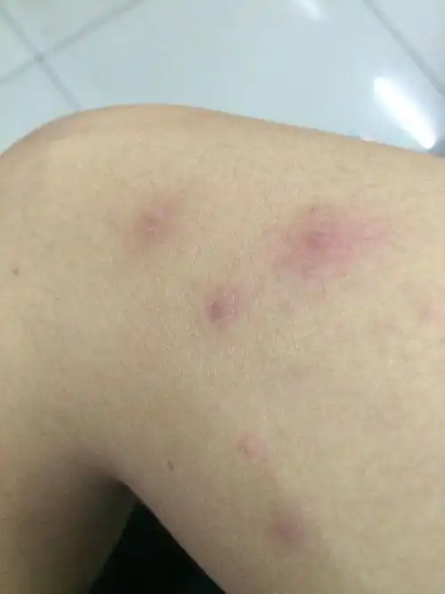 皮肤病 右臂手肘 这是什么东西 是青春痘吗 有点痒