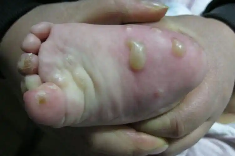 小孩子疥疮脓疱疮图