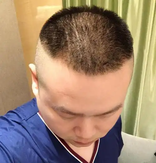 岳云鹏晒照称五年内会秃顶白发,是这样的吗?