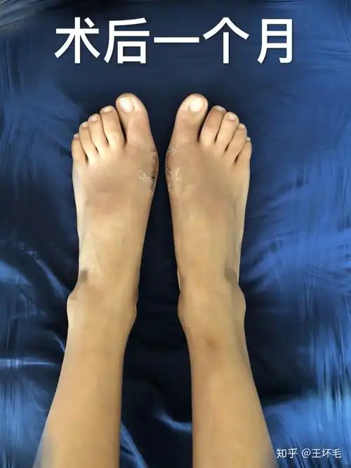 我的拇外翻手术经历五术后一个月间断更新多图