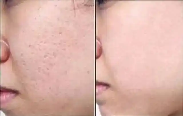 治疗前后对比图治疗后美美的笑容顾客治疗中本诊所专业治疗各种皮肤病