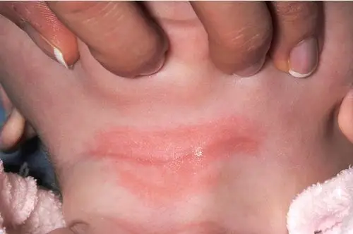 注意新生宝宝脖子易出现这4种问题爸妈要当心