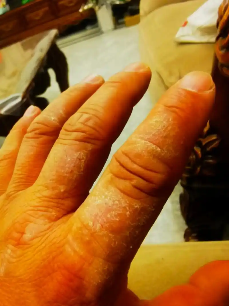 手背干燥脱屑肥厚.特应性皮炎症状.#特应性皮炎