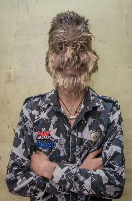 印度13岁男孩天生患有多毛症脸上毛发浓密如同恐怖狼人