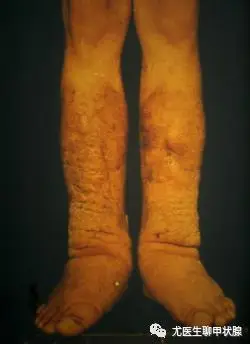 甲亢的皮肤病变您了解吗