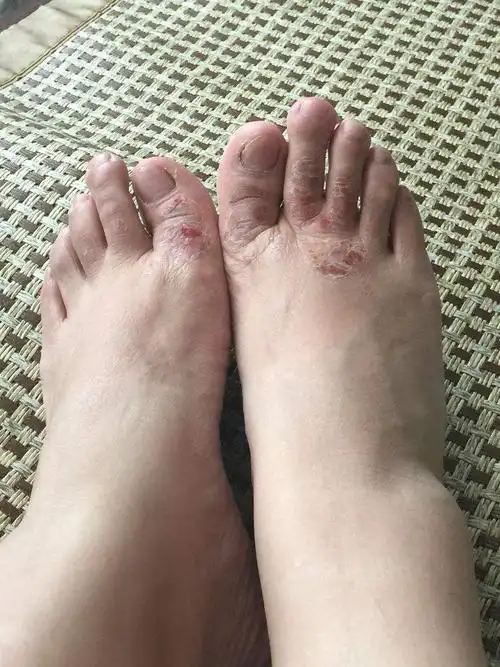 为什么脚臭让我苦不堪言?