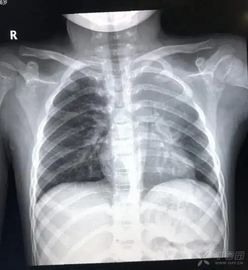 请教:6岁,胸片上肺炎,站立位和躺着拍的范围为什么不一样呢