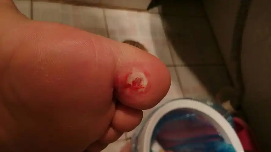 鸡眼被挖出血了现在该怎么办继续贴?还是?好痛好痛苦!求解答