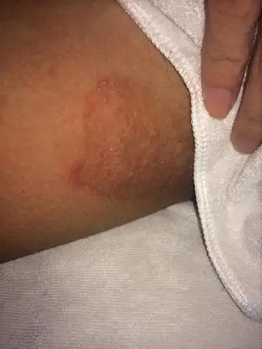 问:大腿内侧长了这个是什么,会痒.