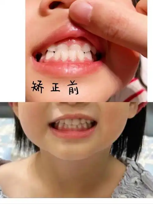 地包天,俗称下牙包上牙,儿童时期越早矫正