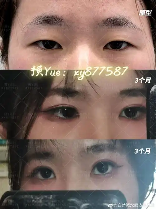 双眼皮##长沙双眼皮##眼综合##暑假##青年美医进阶计划##双眼皮恢复