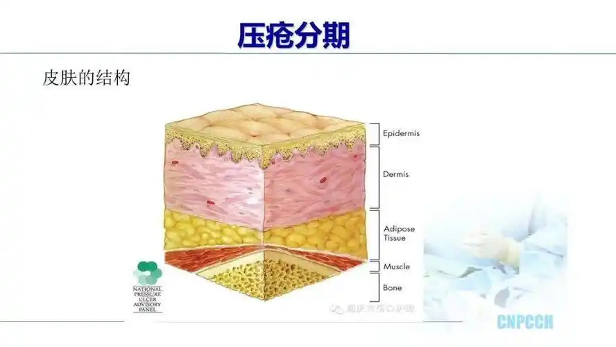 ppt危重患者压疮的治疗及护理