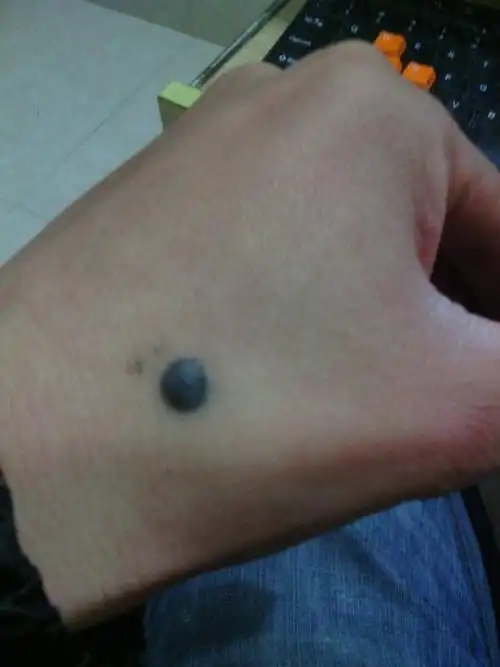 手上长了颗黑痣不知道是什么长了有十几