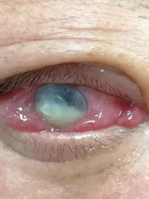 甲亢突眼 角膜溃疡 前房积脓