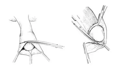 图解包皮手术全过程
