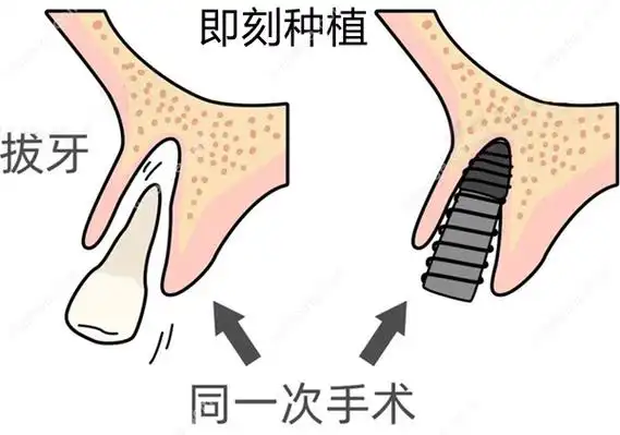 即刻种植牙示意图