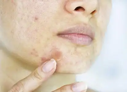 面部皮肤问题, 近距离女性脸上有白石丘疹和痤疮补丁, 疤痕和油性油腻