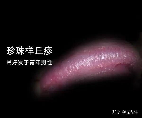 尖锐湿疣假性湿疣傻傻分不清楚内附图片