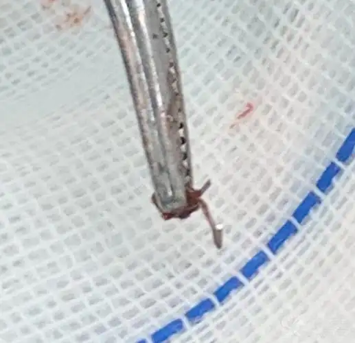 pph的吻合钉在术后最长多长时间仍不脱落?