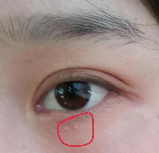 眼睛下面长了两颗脂肪粒,怎么消啊啊啊啊