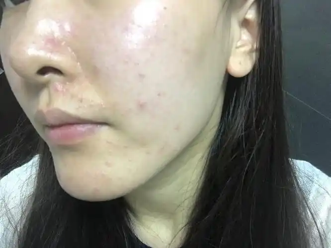 流产之后脸上皮肤开始粗糙油腻一开始是闭合型粉刺现在变成