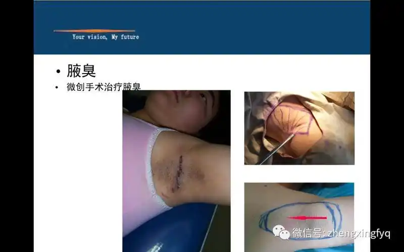 (1))剥离法,就是在腋窝做个切口,把皮肤剥离开,然后把汗腺剪除,这种