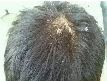 如果你发现头皮屑增多伴头发稀疏,脱落,很有可能是脂溢性皮炎.