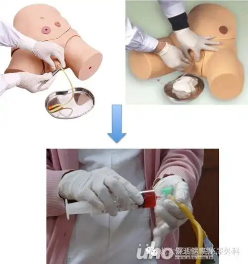 膀胱灌注治疗须知