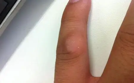 扁平疣是怎么传染的