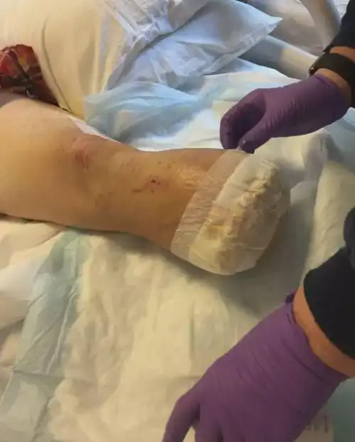 2)修脚皮,却因美甲师误伤她,导致她的脚趾受伤,感染,最终小腿截肢