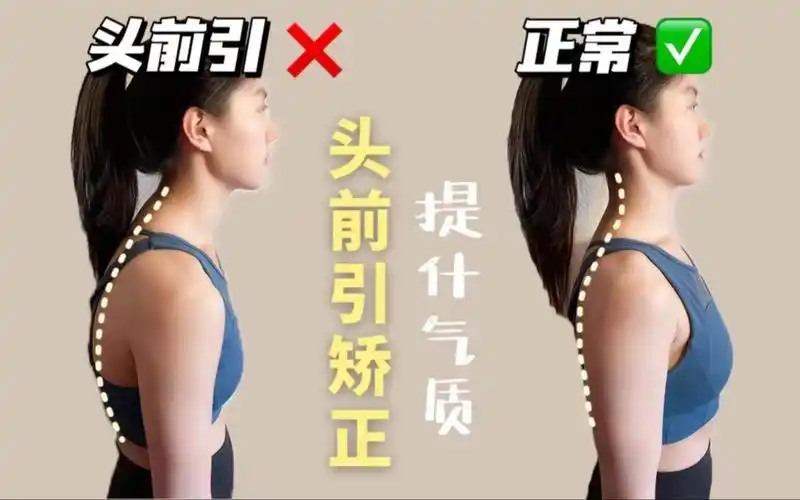 活动  7815一招搞定头前引,颈椎病73提升气质