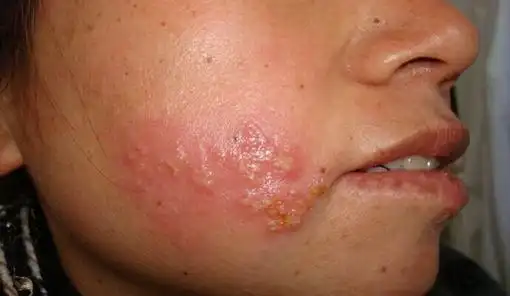 淋病潜伏期是多久